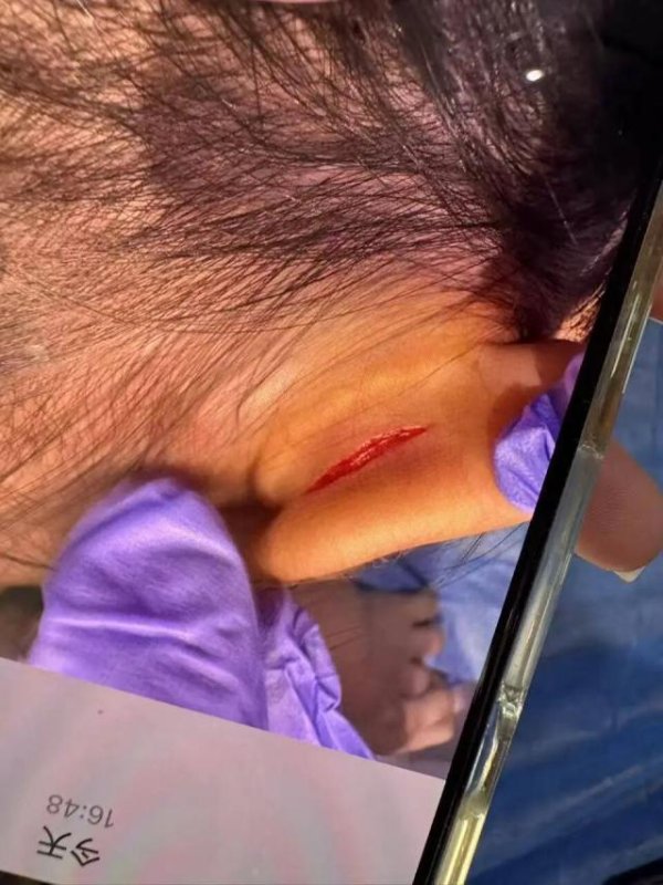 宝货配资 武汉一女童上高端托儿班耳朵疑被撕裂，家长：一年费用超10万，院方说事发教室监控坏了